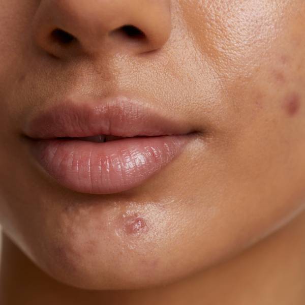 Acne-Scar-Treatment
