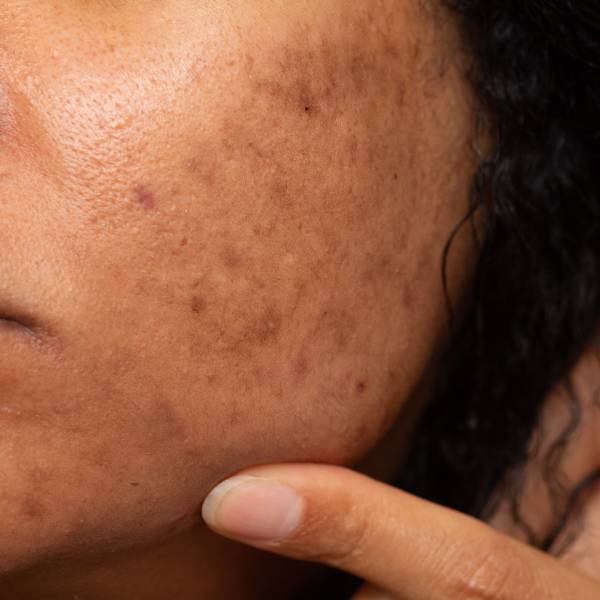 Melasma-Pigmentation